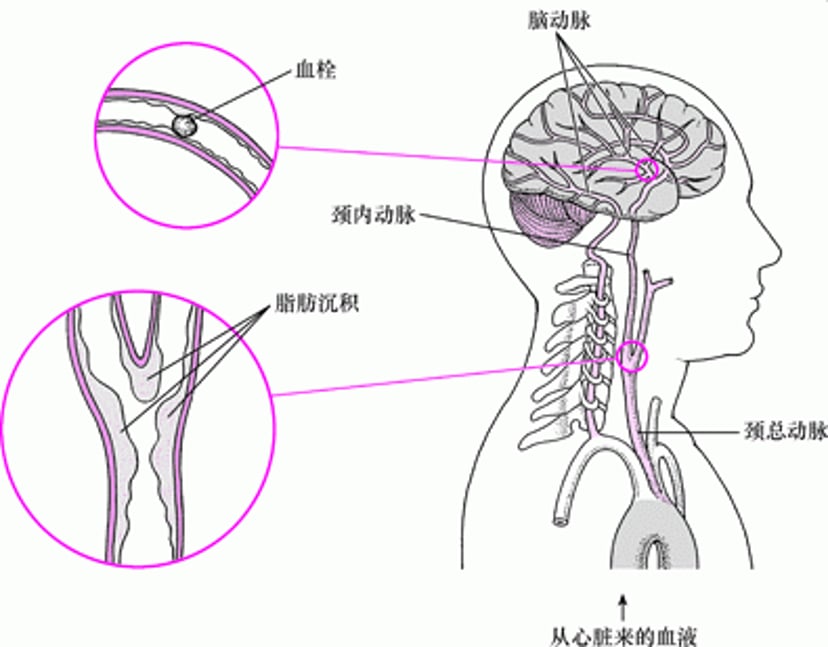 爆发和破裂：出血性卒中的病因