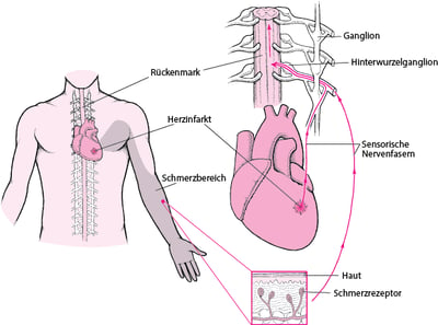 Was ist Schmerzübertragung?