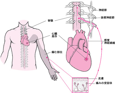 関連痛とは