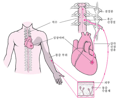 연관 통증이란 무엇입니까?