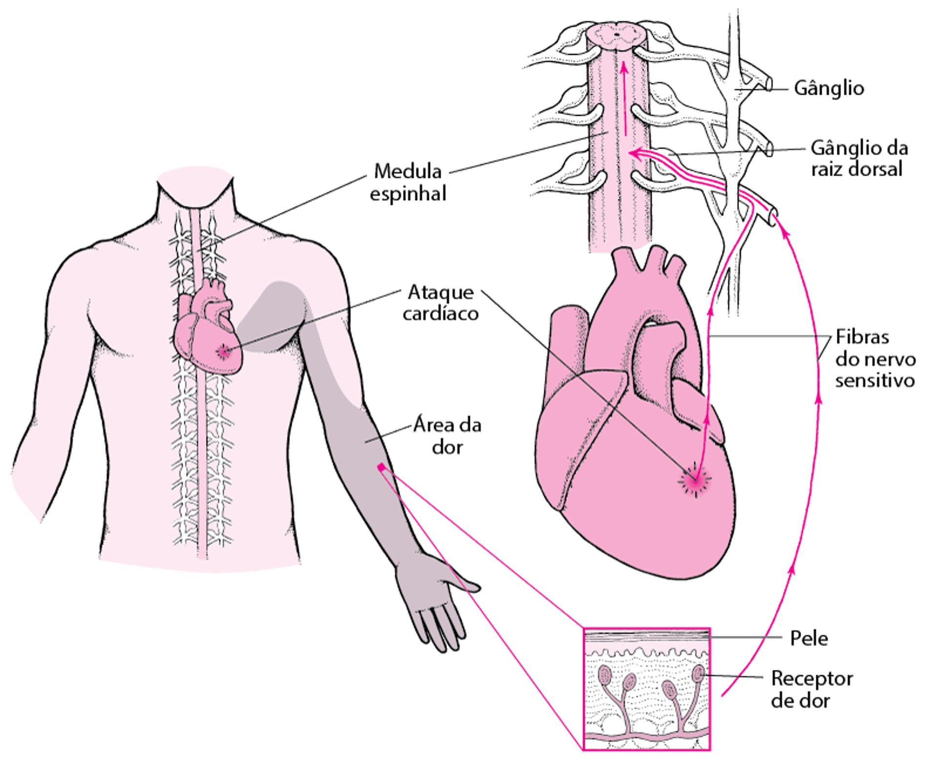 O que é a dor referida?