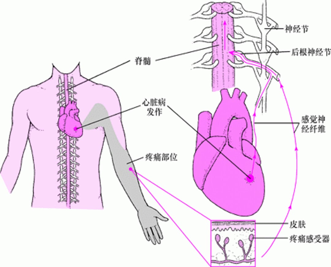 牵涉痛是什么？