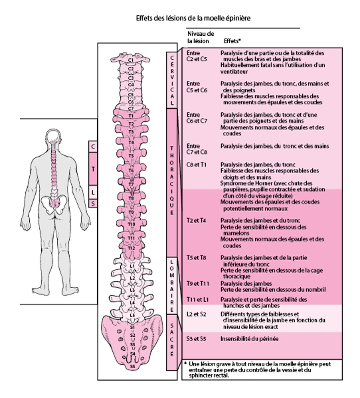 Où la moelle épinière est-elle endommagée ?
