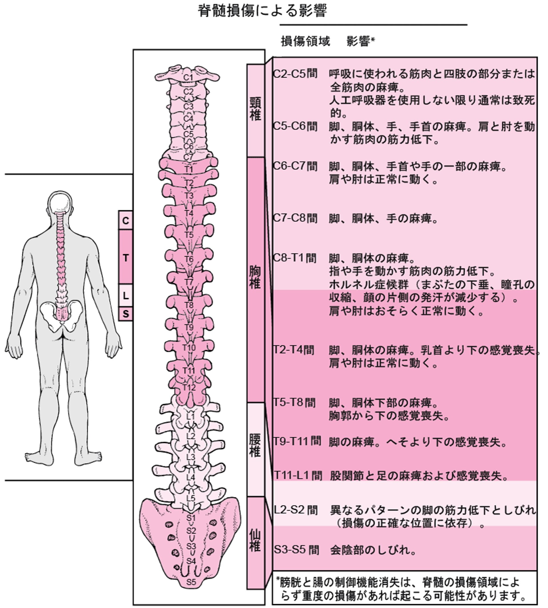 脊髄の損傷領域とその影響