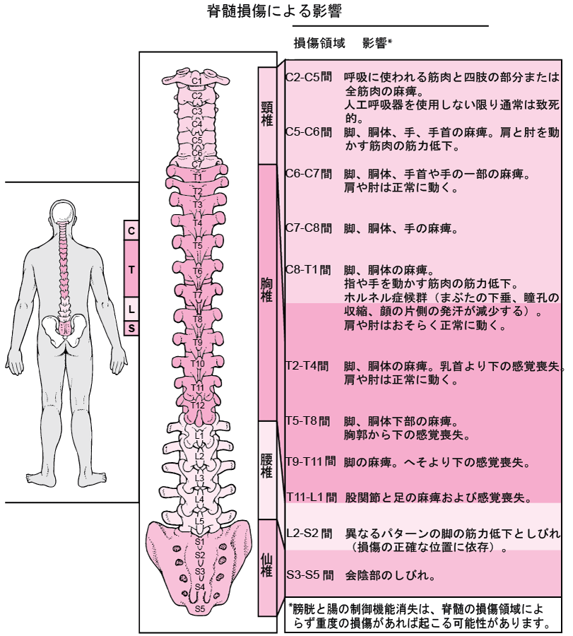 脊椎および脊髄の損傷 - 外傷と中毒 - MSDマニュアル家庭版