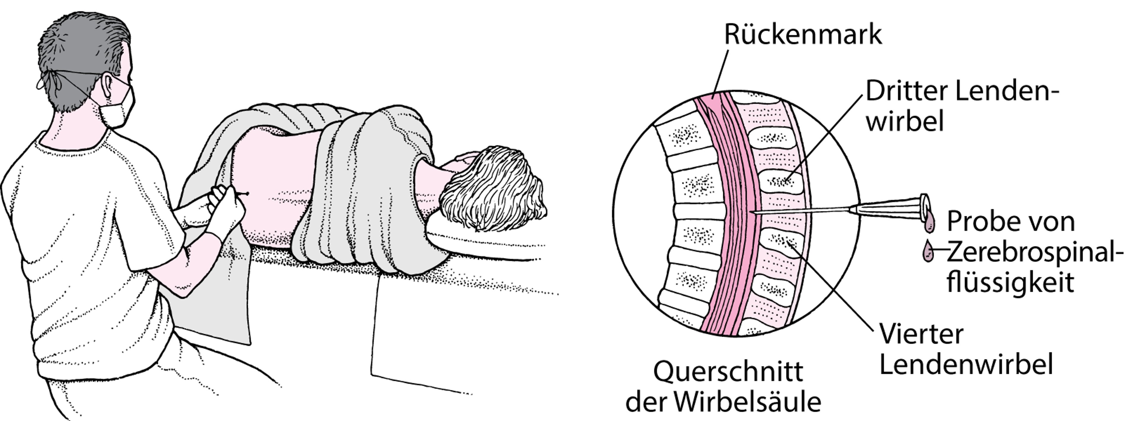 Wie wird eine Spinalpunktion vorgenommen?