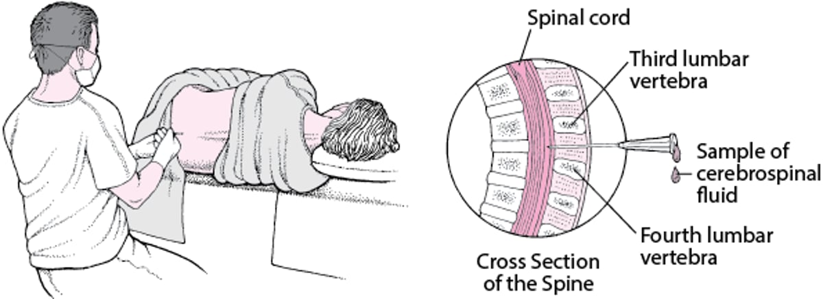 Spinalpunktion