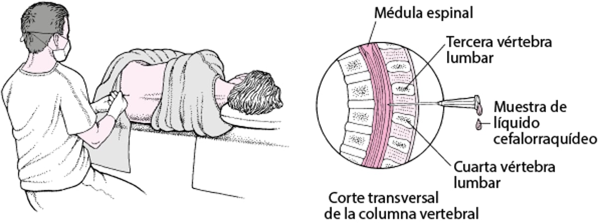 Punción lumbar