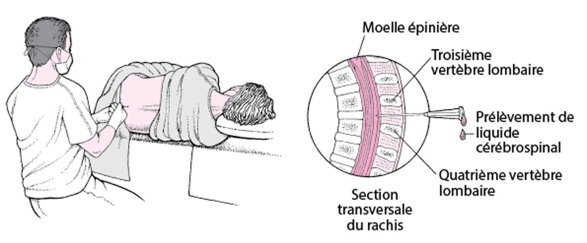 Ponction lombaire