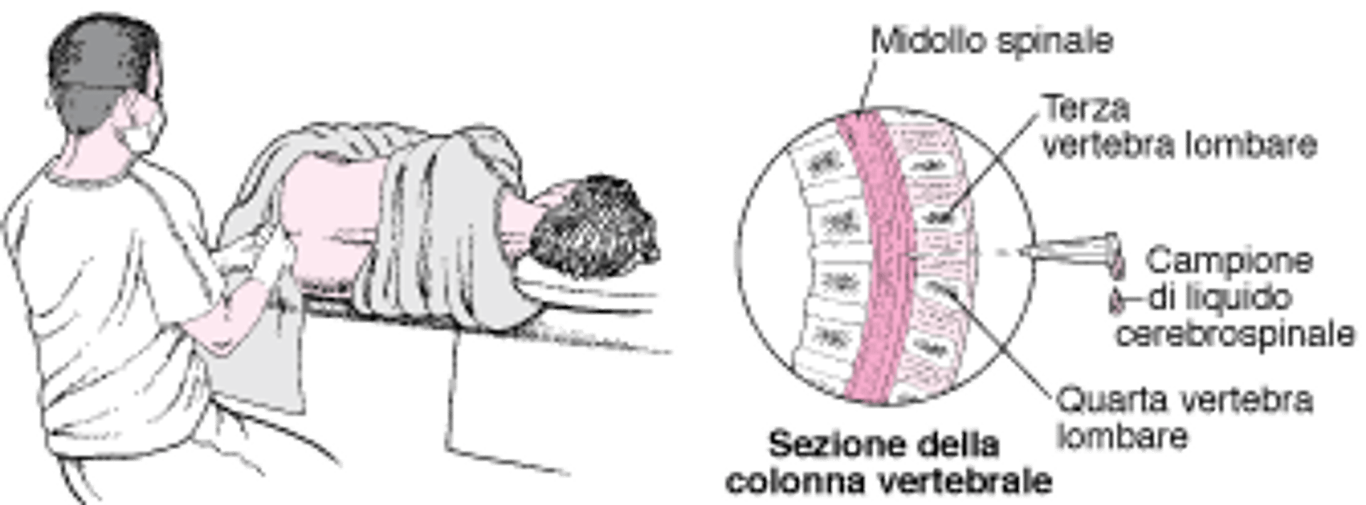 Come viene effettuata una puntura lombare