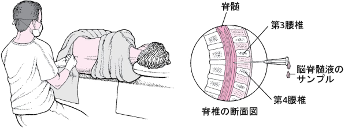 <ruby >腰椎穿刺<rt >ようついせんし</rt></ruby>