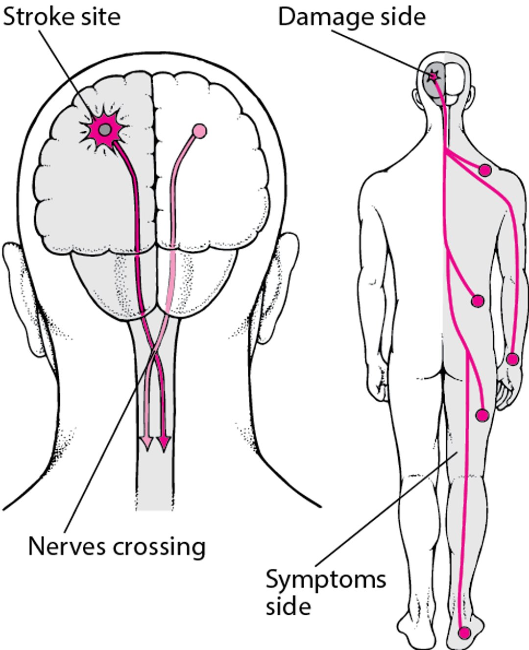 Why Strokes Usually Affect Only One Side of the Body