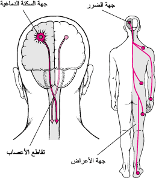 لماذا تؤثر السكتات الدماغية عادةً في جانب واحد فقط من الجسم