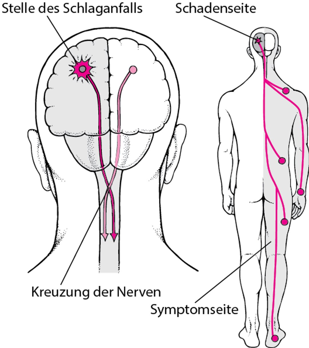 Warum bei einem Schlaganfall für gewöhnlich nur eine Körperhälfte betroffen ist