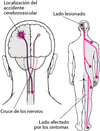 Por qué los accidentes cerebrovasculares por lo general afectan solo a un lado del cuerpo