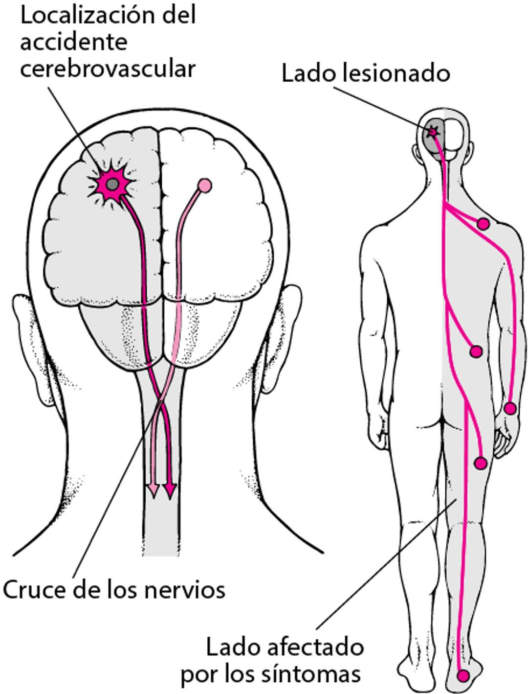 Por qué los accidentes cerebrovasculares por lo general afectan solo a un lado del cuerpo