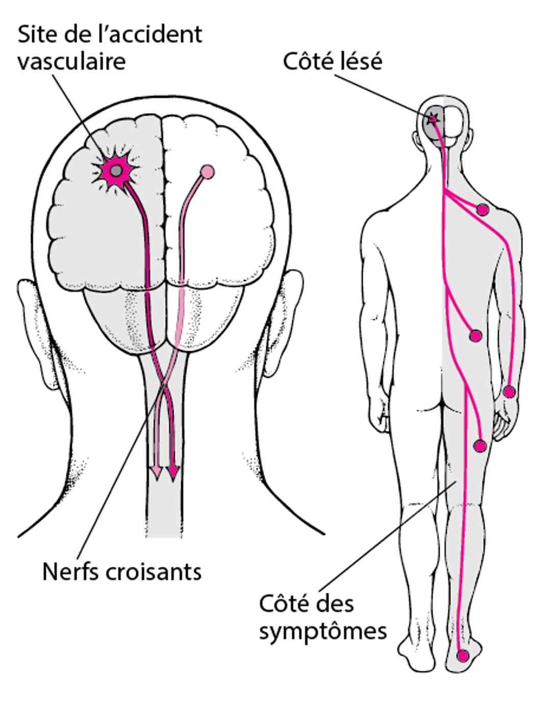 Pourquoi les AVC ne touchent généralement qu’un seul côté du corps