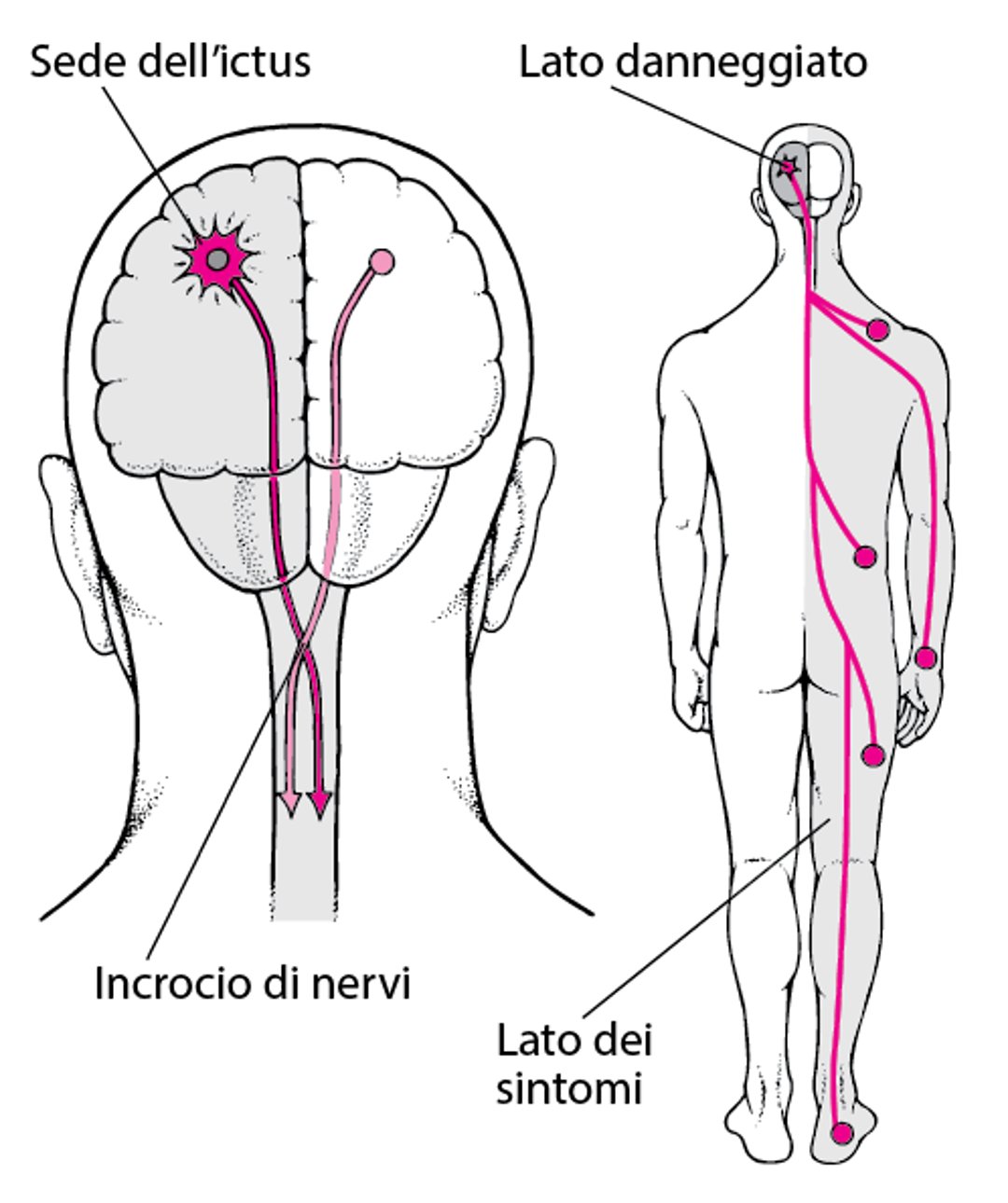 Perché l’ictus di solito colpisce un solo lato del corpo