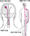 脳卒中で通常は体の片側だけに症状が現れる理由