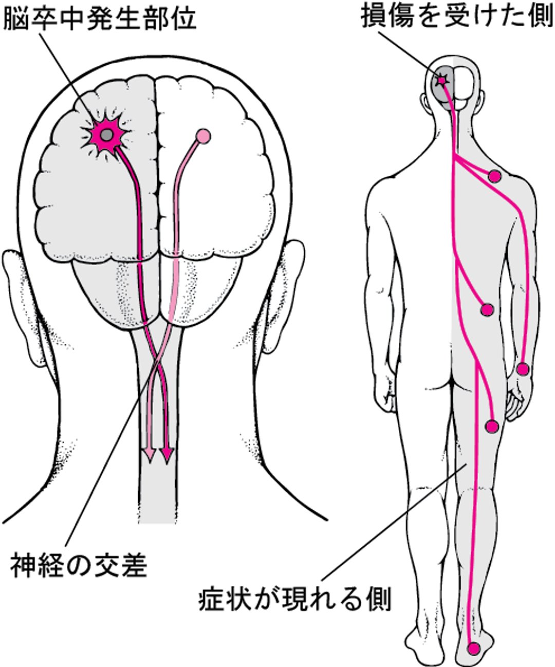 脳卒中で通常は体の片側だけに症状が現れる理由
