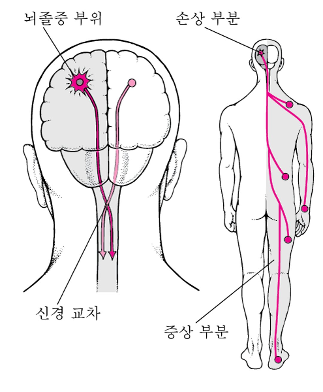 뇌졸중이 대개 신체의 한쪽에만 영향을 미치는 원인