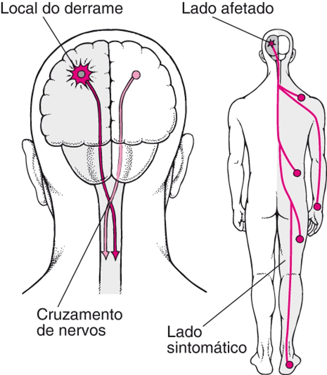 Por que os acidentes vasculares cerebrais costumam afetar apenas um lado do corpo