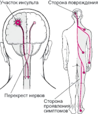 Почему инсульты обычно поражают только одну сторону тела
