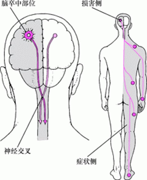 为什么中风通常只影响身体的一侧