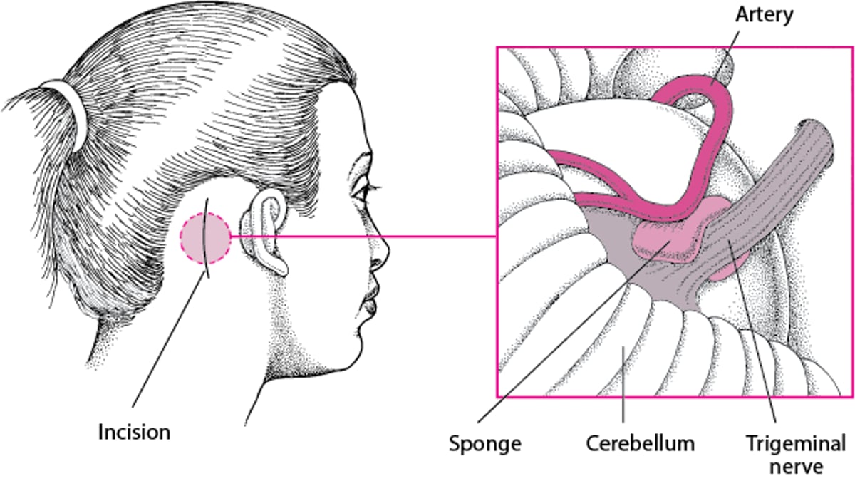 Taking the Pressure Off a Nerve