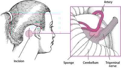 Taking the Pressure Off a Nerve