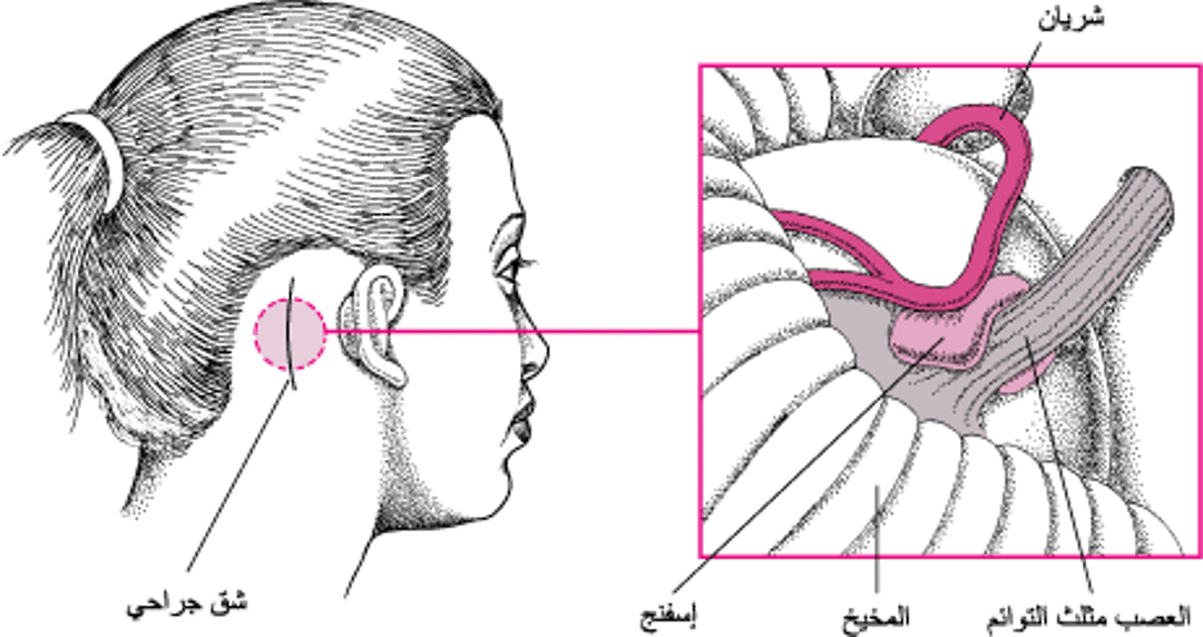 إزالة الضغط عن عصبٍ