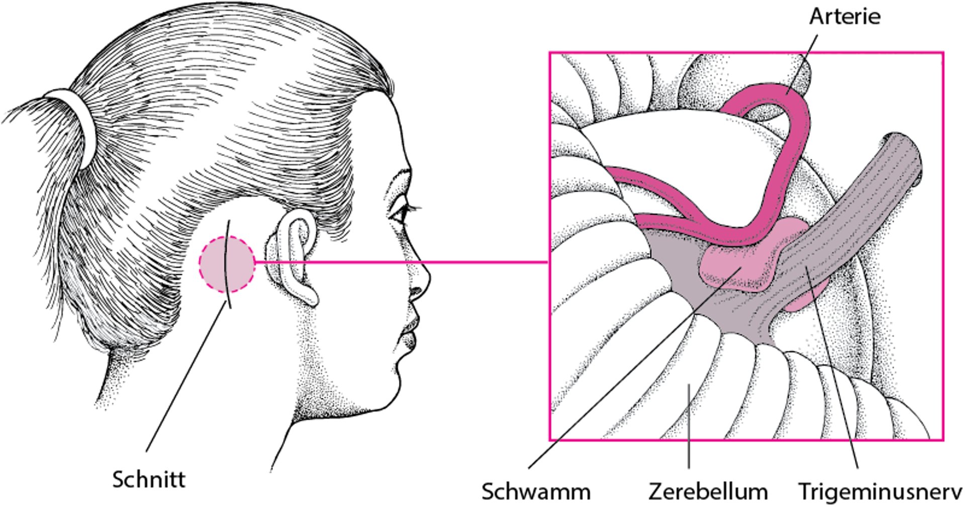 Entlastung von Nerven