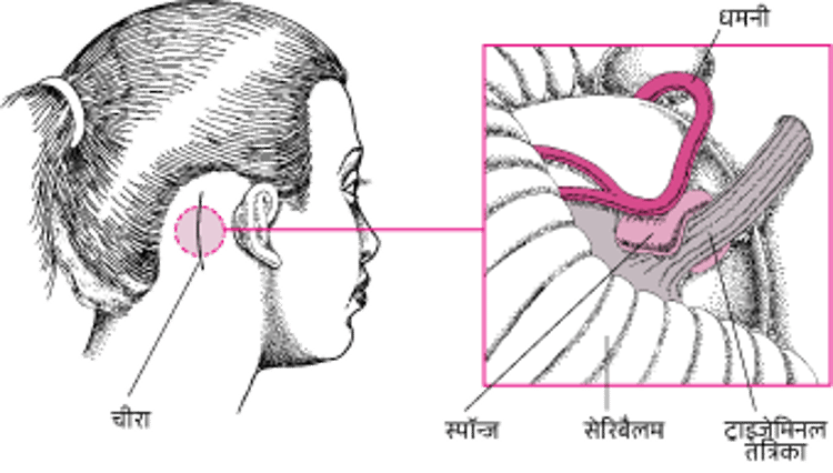 तंत्रिका को दबाना