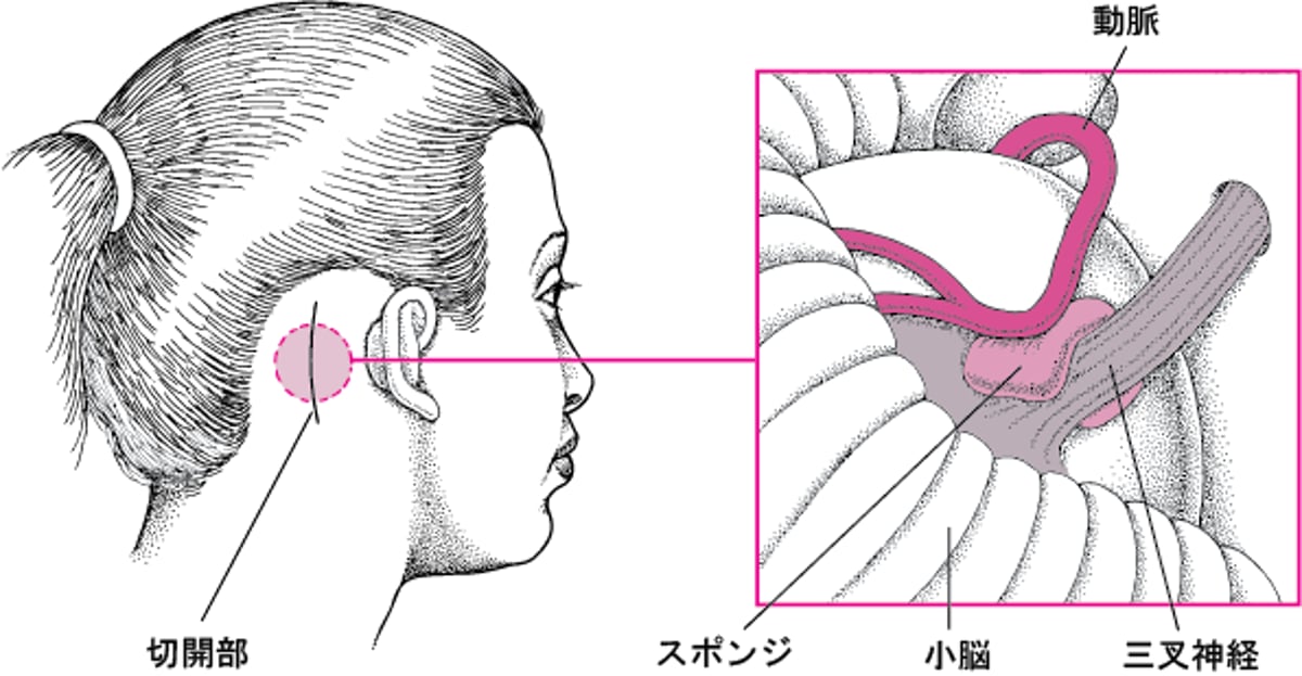 神経の圧迫を取り除く