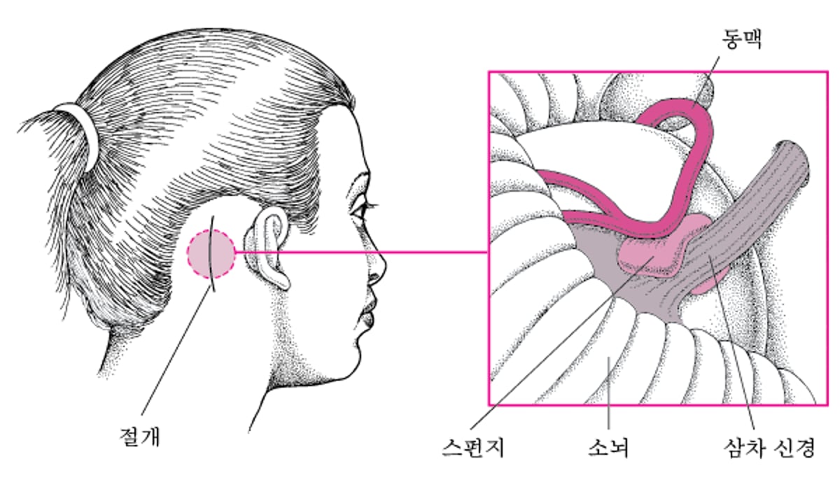 신경 압박 경감