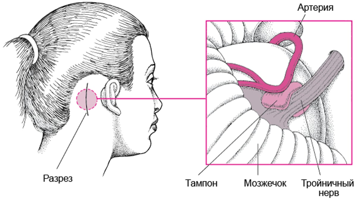 Устранение сдавления нерва