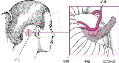 神经减压术