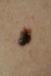 Melanoma nodular