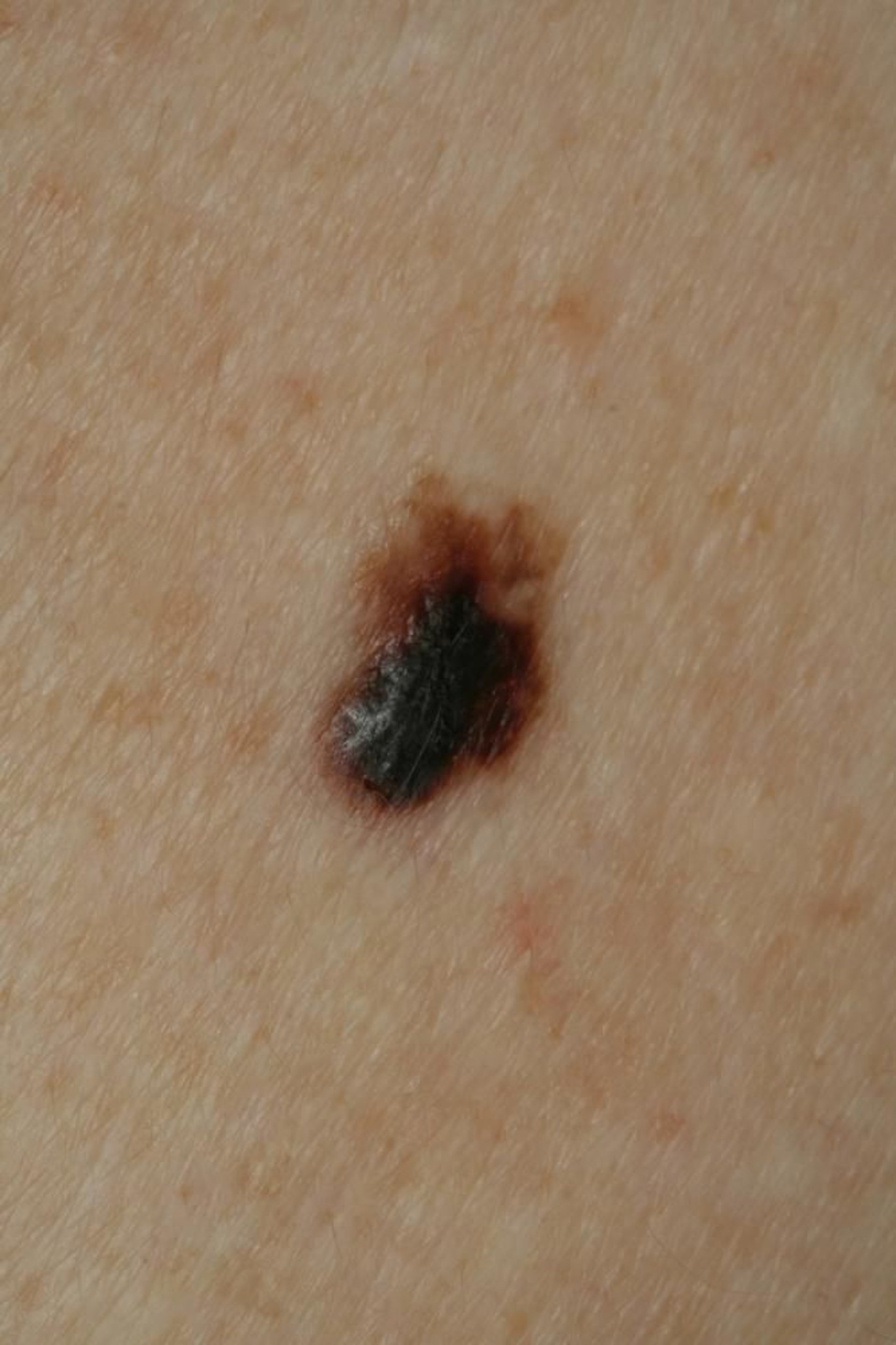 Melanoma