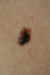 Melanoma