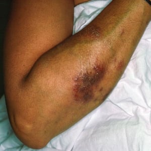 Dermatitis numular