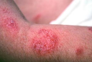 Dermatitis numular
