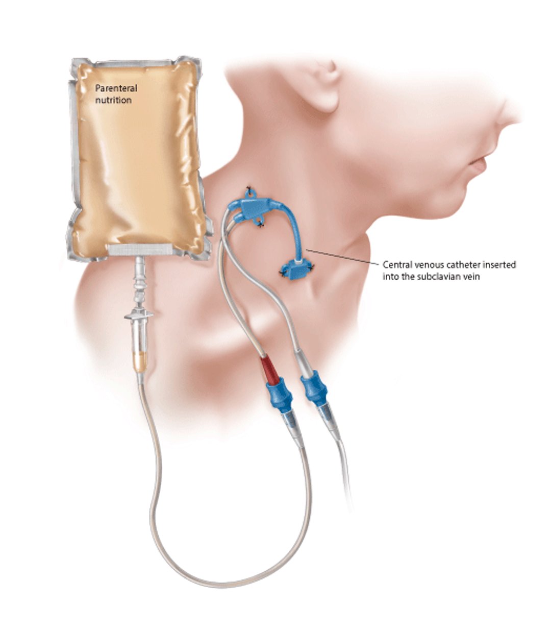 Intravenous Feeding (Parenteral Nutrition)