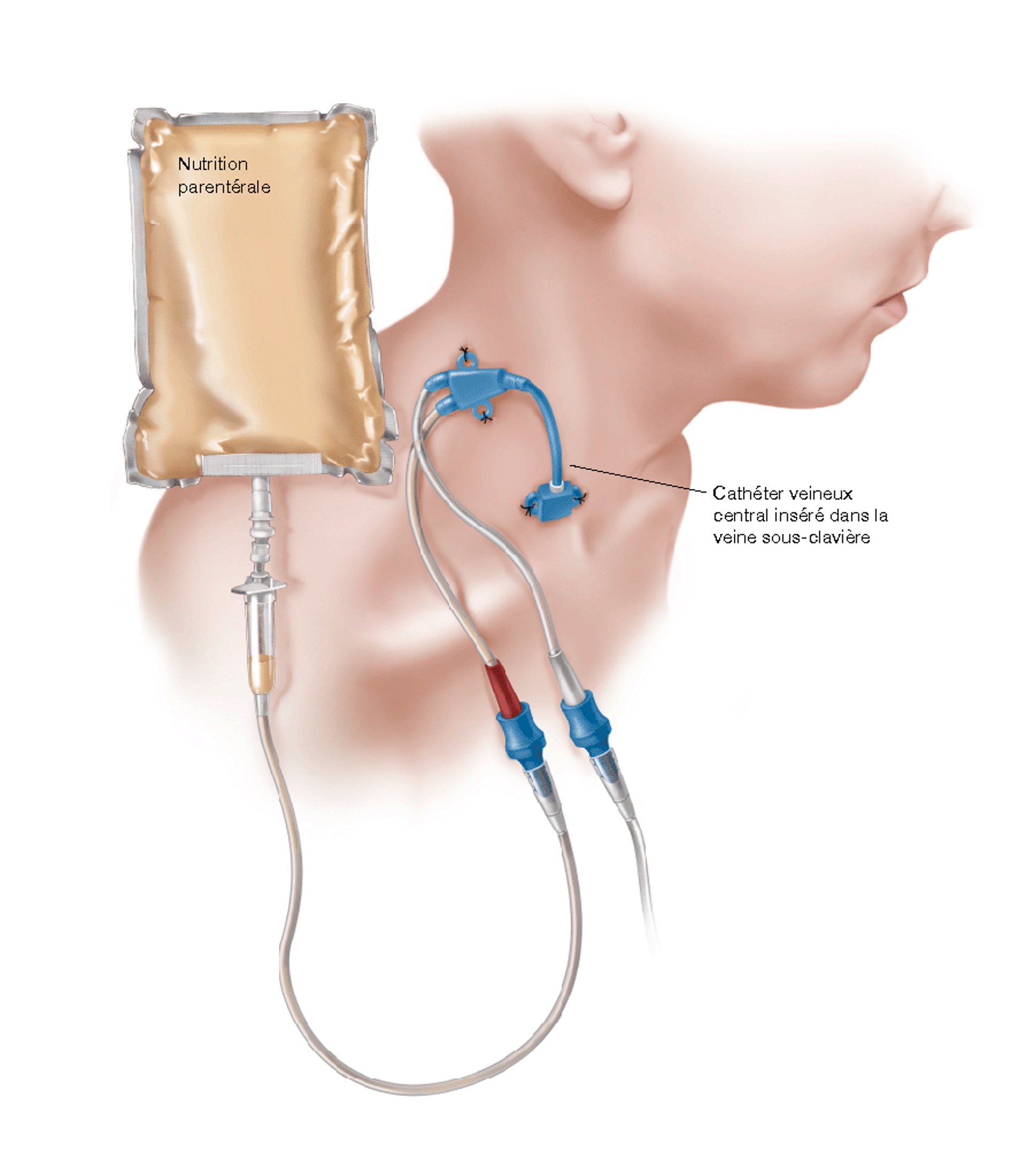 Alimentation par voie intraveineuse (nutrition parentérale)