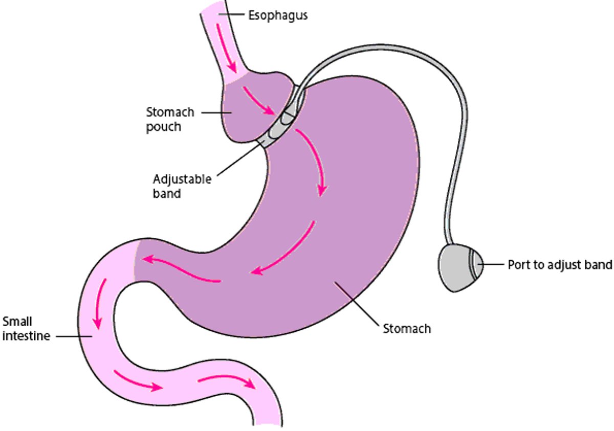 Banding the Stomach
