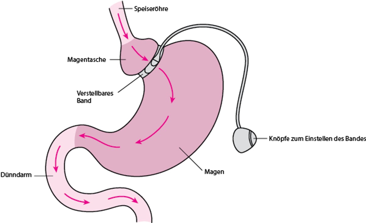 Einfügen eines Magenbands