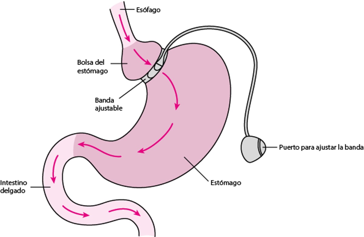 Cerclaje del estómago (cerclaje gástrico)