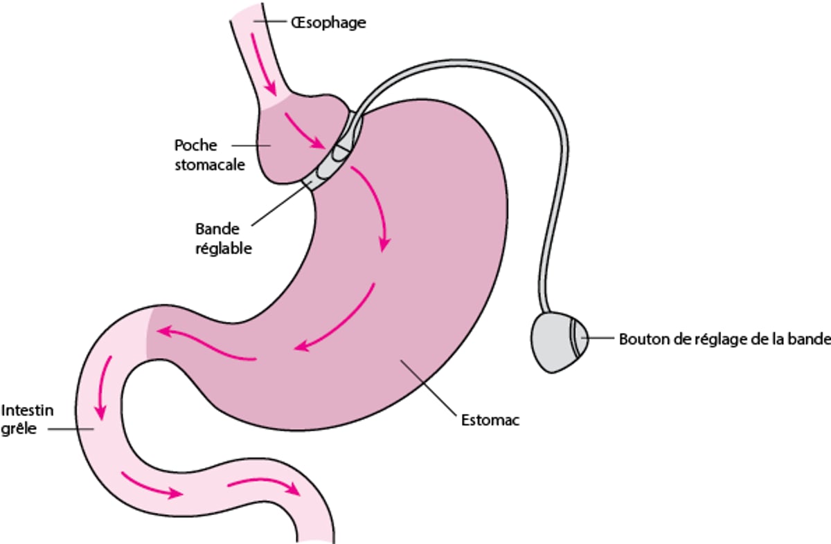 Pose d’une bande gastrique