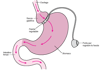 Bendaggio gastrico