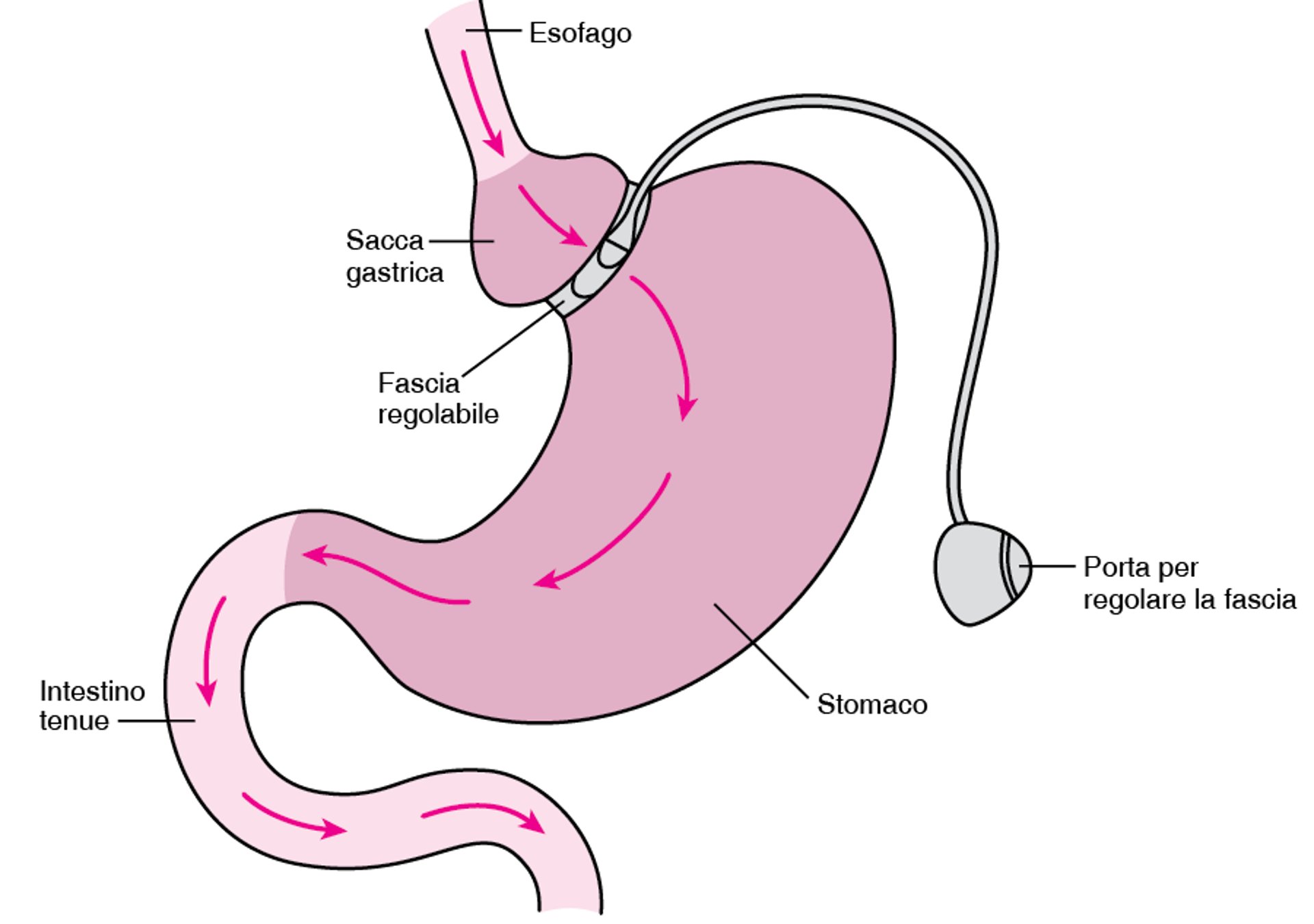 Bendaggio gastrico